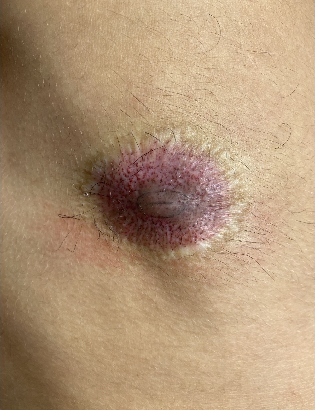 After 3D areola tattoo — restored symmetrical areola after top surgery, Aesthetic By Reese Sydney