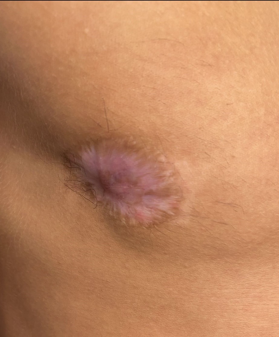 Before 3D areola tattoo — asymmetrical areola after FTM top surgery, nipple necrosis, Aesthetic By Reese Sydney