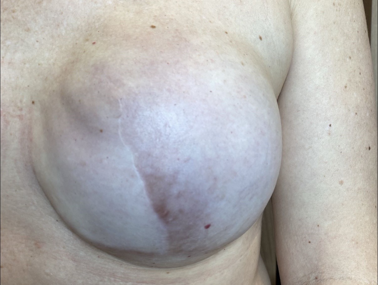 Before areola tattoo — thin stretched breast skin after breast reconstruction, Aesthetic By Reese Sydney